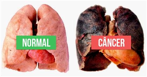 cancer de pulmão